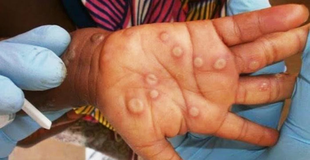 mpox case